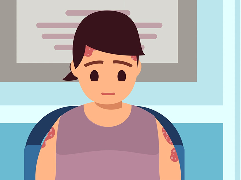 Paediatric psoriasis